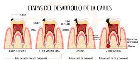 Diagrama de la progresión de la caries dental a través de las capas del diente