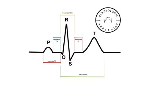 Gráfico de ECG mostrando cambios en el segmento ST