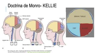 Diagrama de la teoría de Monro-Kellie