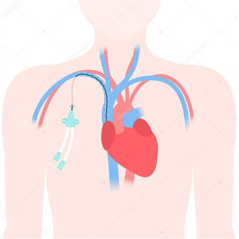 Ilustración de un catéter intraparenquimatoso siendo insertado