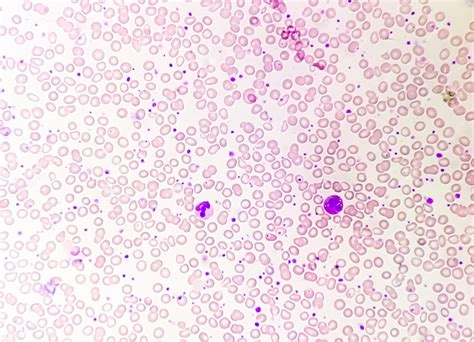 Análisis de sangre con microscopio mostrando plaquetas de diferentes tamaños