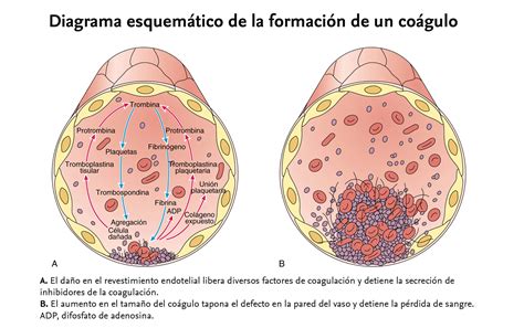 Diagrama del proceso de aterotrombosis mostrando la formación de un coágulo plaquetario